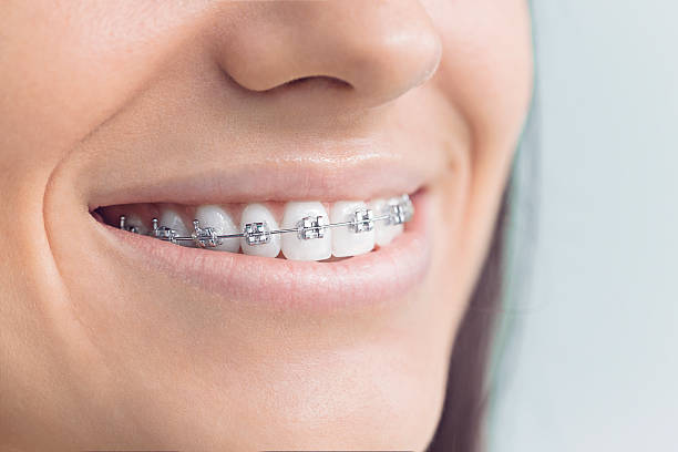 Best Teeth Whitening  in North Rock Springs, WY